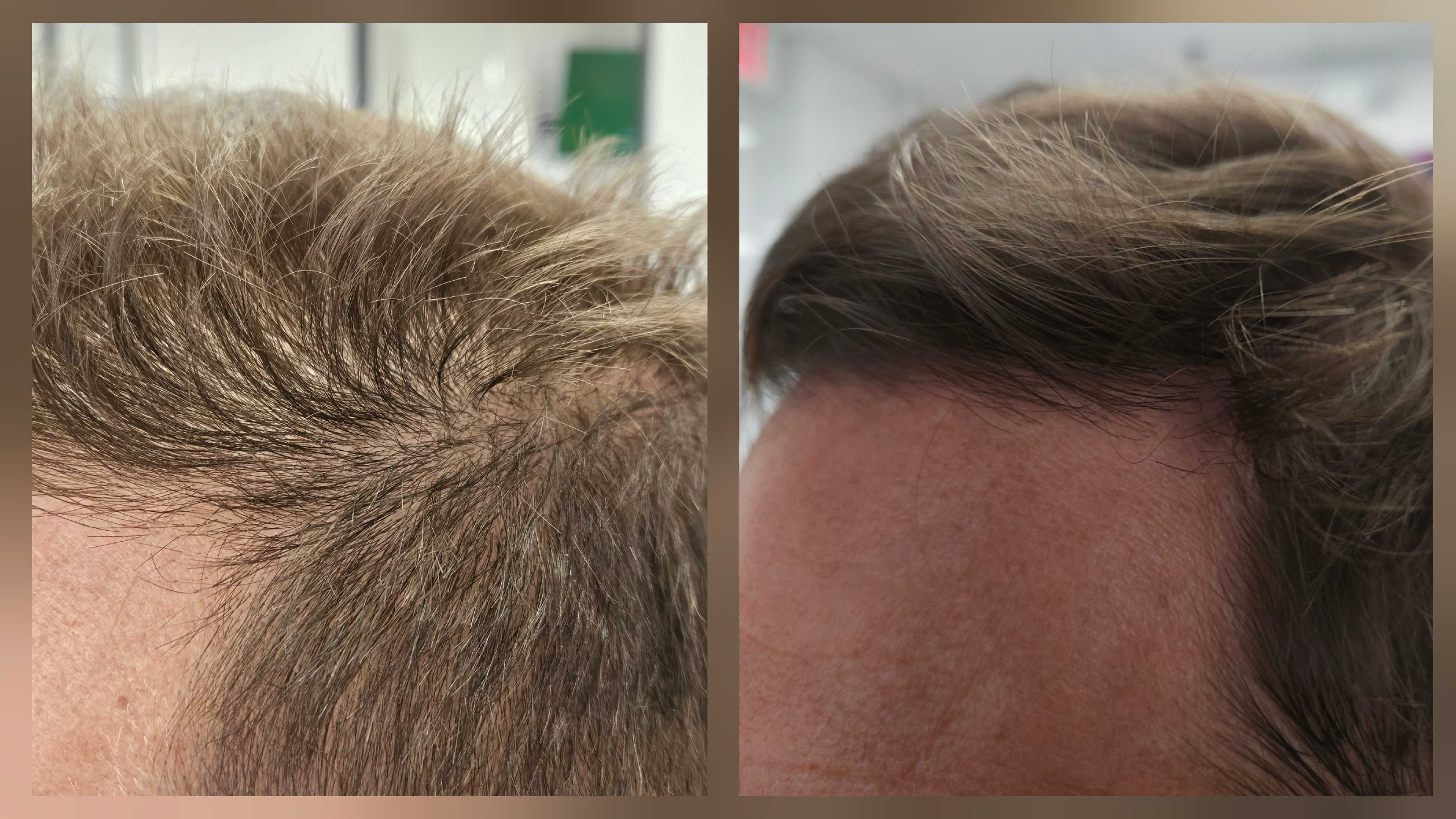 Before and after hair regrowth, NuWav client